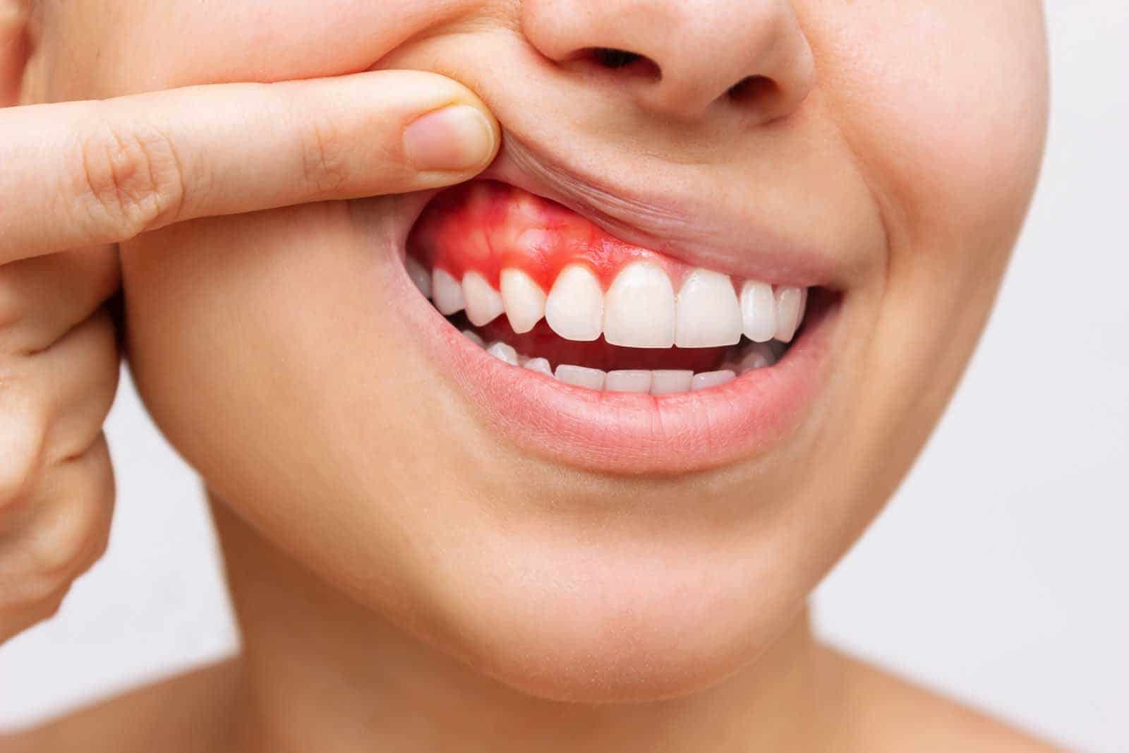 Bleeding Gums & Causes Sudent - Oral and Dental Health Polyclinic