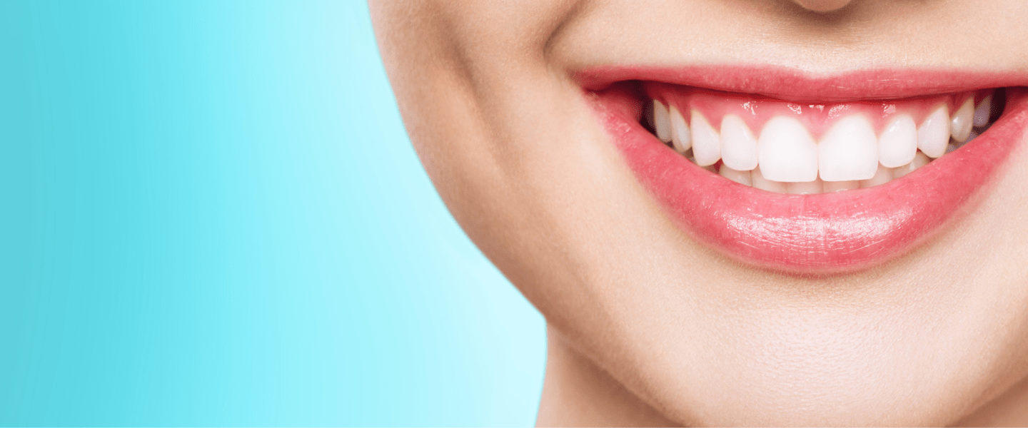 Teeth Whitening (Bleaching)